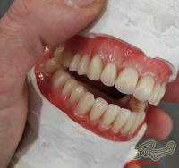 لابراتوار دندانسازی دندان مصنوعی