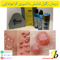 اسپری کرایوتراپی نیتروکسی درمان زگیل تناسلی