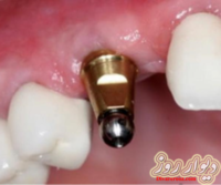 دندانپزشکی-جشنواره ایمپلنت دندان